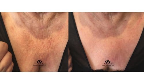 Ulthera before and after, result 14