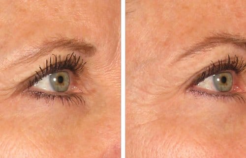 Ulthera before and after