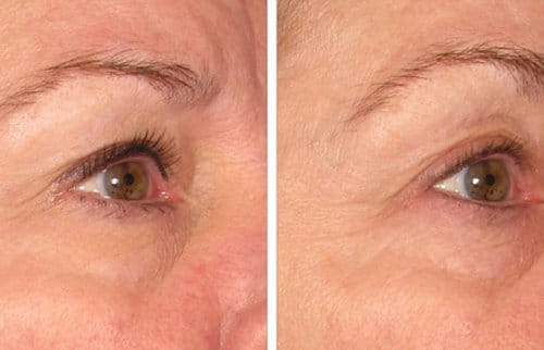 Ulthera before and after