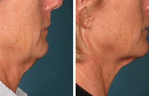 Ulthera before and after, result 3