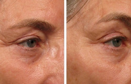 Ulthera before and after, result 4