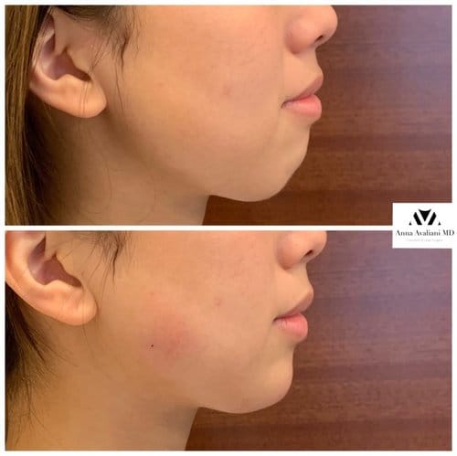 Non Surgical Chin Augmentation before and after, result 9