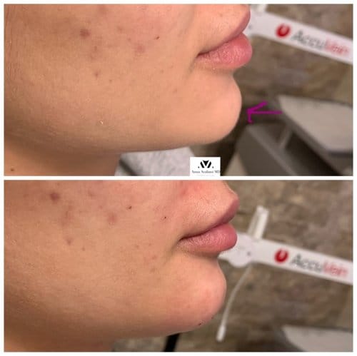Non Surgical Chin Augmentation before and after, result 10