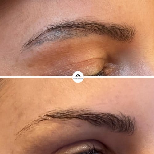 Tattoo Eyebrow Removal before and after, result 8