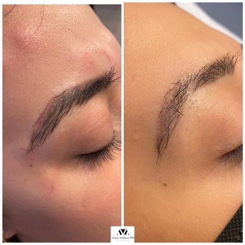 Tattoo Eyebrow Removal before and after, result 4