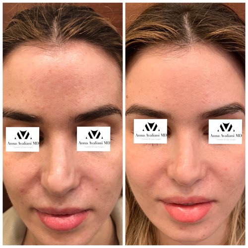 Picosure / Laser Skin Rejuvenation Before and After - IMG 1464 2