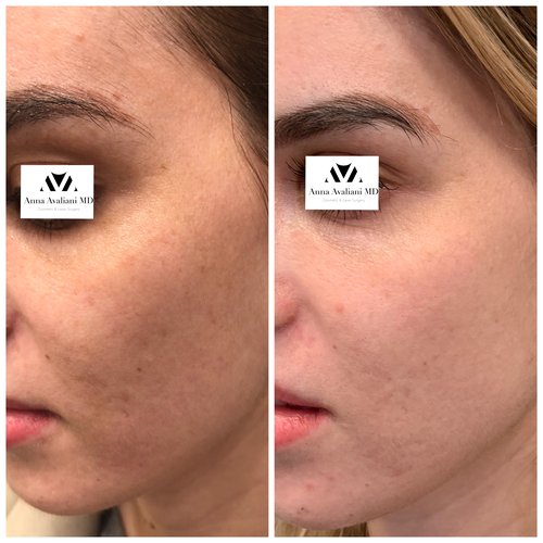 Picosure / Laser Skin Rejuvenation Before and After - IMG 1465 2