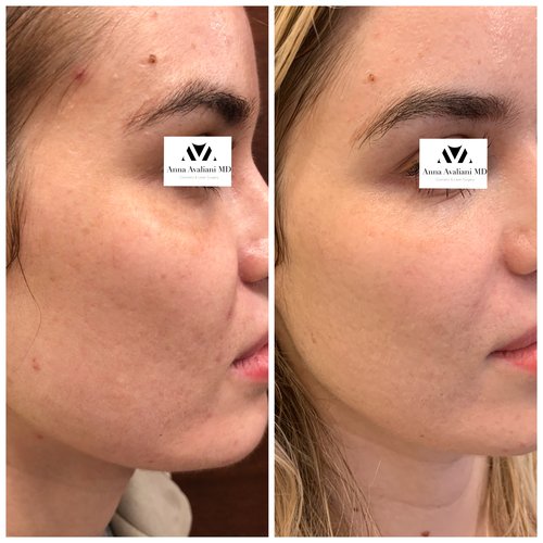 Picosure / Laser Skin Rejuvenation Before and After - IMG 1466
