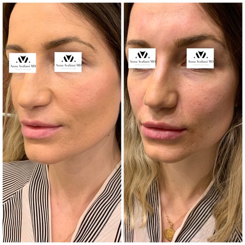 Fillers Before and After - IMG 6058
