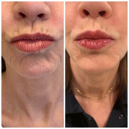 Lip Augmentation Before and After - IMG 7052