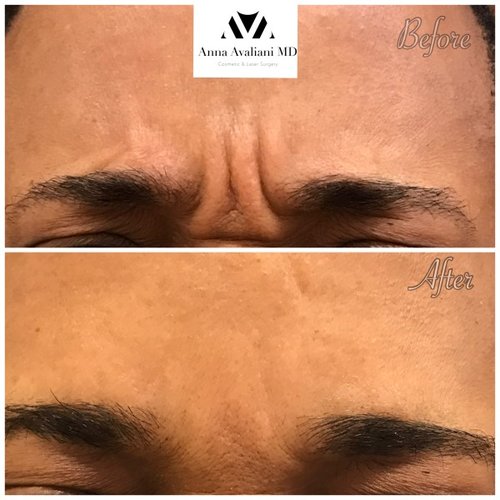 Botox Before and After - bbt11