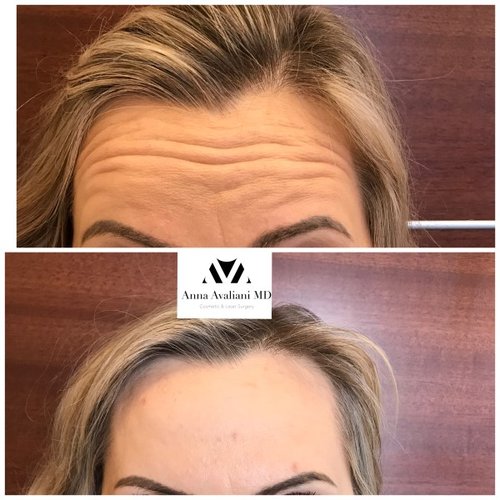 Botox Before and After - bbt5