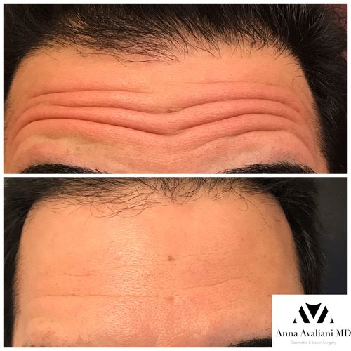 Botox Before and After - bx22