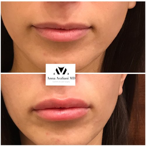 Lip Augmentation Before and After - lp2