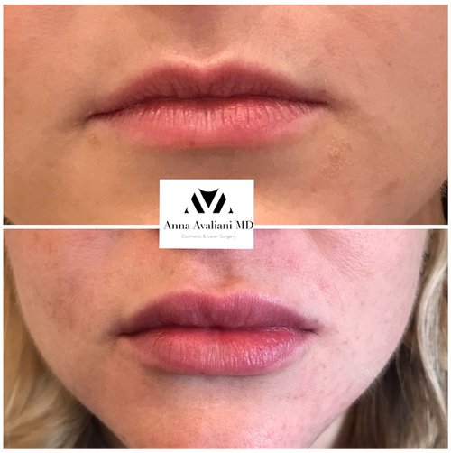 Lip Augmentation Before and After - lp5