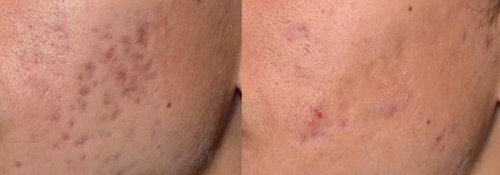 Picosure / Laser Skin Rejuvenation Before and After - skin8