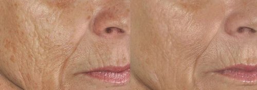 Picosure / Laser Skin Rejuvenation Before and After - skin9-1